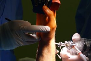 arestin post op instructions pdf